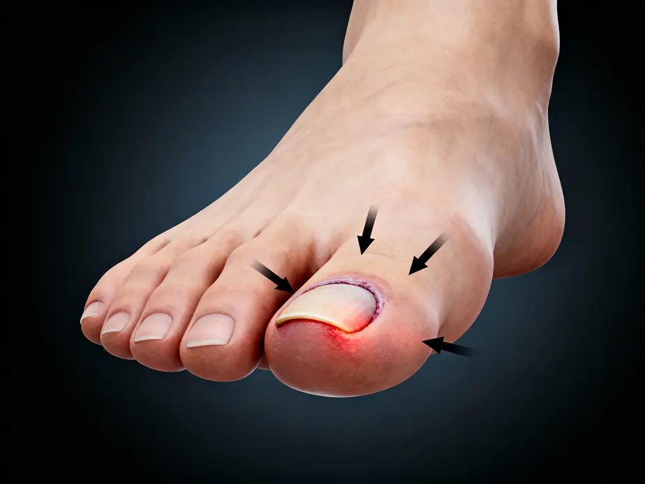 Illustration showing the anatomy of an ingrown toenail and its associated risks.